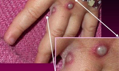 Monkeypox virus symptoms, treatment, vaccine and death rate