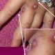 Monkeypox virus symptoms, treatment, vaccine and death rate
