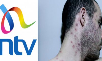 NTV Earns Gangster Points After Using Wazungu’s Photos to Report Monkeypox