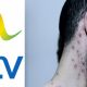 NTV Earns Gangster Points After Using Wazungu’s Photos to Report Monkeypox
